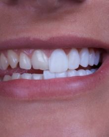 Come migliorare il tuo sorriso con le faccette dentali